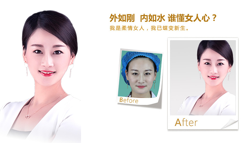 黔东南V脸、线雕隆鼻